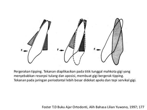 gigi tipping|Pergerakan Gigi (Tooth Movement) .